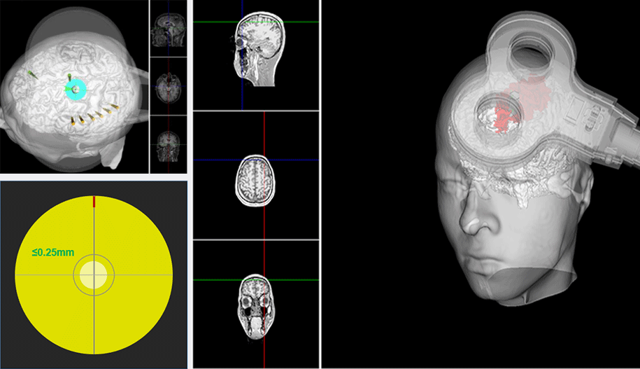 Multi-Target Stimulation/Automatic MT Detection 