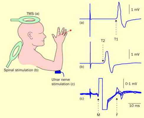 Calculation method of central motor conduction time - magnetic stimulation measurement method
