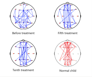 Graph. Topology of brain network