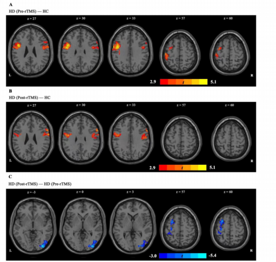 the functional connectivity between the left IPL and the whole-brain network