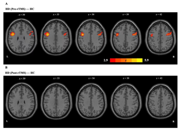 the functional connectivity between the right IPL and the whole-brain network after transcranial magnetic stimulation.